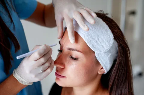 Blanching, wrinkle filling technique with Belotero filler