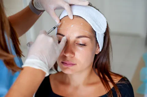 Blanching, wrinkle filling technique with Belotero filler