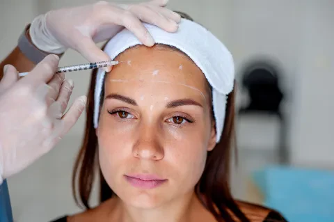 Blanching, wrinkle filling technique with Belotero filler